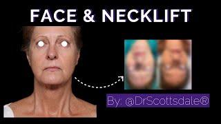 FACE & NECKLIFT by @DrScottsdale