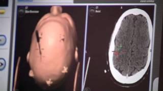 AutoLITT - A Minimally Invasive Brain Tumor Treatment