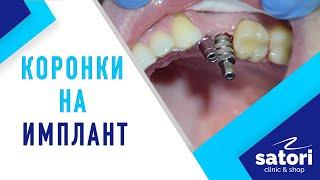 Имплантация зубов коронки на импланты снятие оттиска фиксация коронок