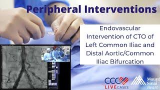 Endovascular Interv. of CTO of L Common Iliac & Distal AorticCommon Iliac Bifurcation- 41614 Case