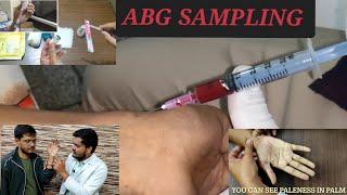 ABG SAMPLING TECHNIQUE