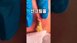 여드름 났을때 이렇게 선크림바르세요이거 모르면 피부 망가집니다