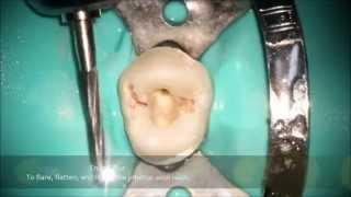 First Maxillary Premolar