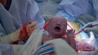 Live birth C-section surgery