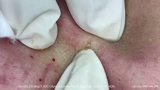 Big Cystic Acne Blackheads Extraction Blackheads & Milia Whiteheads Removal Pimple Popping