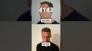 6 Months Hair Transplant Results #shorts