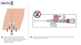 BD Venflon I - I.V Cannula with BD Instaflash Needle Technology