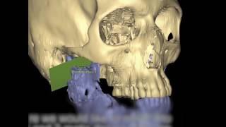 3D Printing is Revolutionizing Facial Reconstructive Surgery