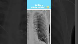 Can you find the pneumothorax? Pt 1 #shorts #cxr #radiology