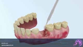 Medical animation  Removal of the affected tooth