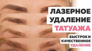 Лазерное удаление татуажа. Можно ли удалить татуаж быстро качественно и БЕСПЛАТНО?