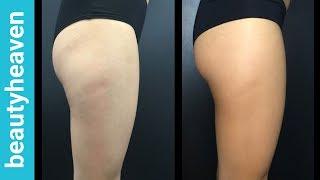I Tried A Cellulite Treatment And It Actually Worked