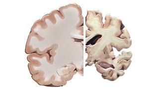 Alzheimers and the Brain