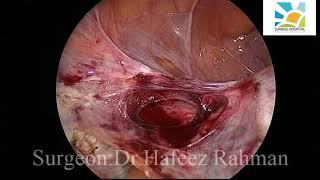 Case of previous 3 LSCS underwent TLH using the lateral window technique for bladder dissection