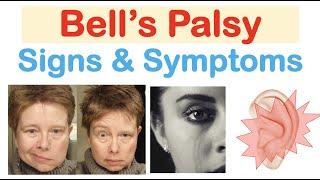Bell’s Palsy Facial Paralysis Signs & Symptoms & Why They Occur