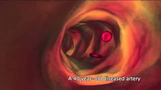 What is atherosclerosis ?