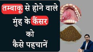 तम्बाकू से होने वाले मुंह के कैंसर की पहचान  मुंह के कैंसर से कैसे बचें  Tobacco mouth cancer