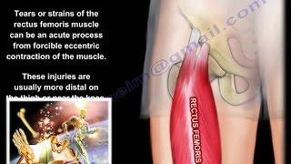 Hip Pain Strain Of The Rectus Femoris  anatomy - Everything You Need To Know - Dr. Nabil Ebraheim