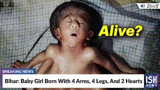 Bihar Baby Girl Born With 4 Arms 4 Legs And 2 Hearts  ISH News