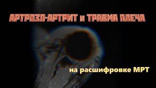 Признаки ТРАВМЫ плеча АРТРОЗО АРТРИТ и разрыв суставной губы на РАСШИФРОВКЕ МРТ плечевого сустава