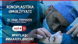 Rinoplastika Burun plastik emeliyyati tam izle - Dr. Vuqar Ferhadov LOR Estetik Cerrah MEDPLUS