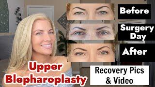 Upper Blepharoplasty Eyelid Surgery - Recovery Pics and Videos  Before & Afters