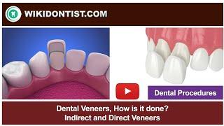 Dental Veneers - Dental Procedures  A Video by Dr. Thomas Nechupadam