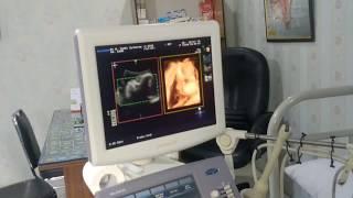 USG 3D Kehamilan 8 Bulan  31 Minggu  Kartika & Satya