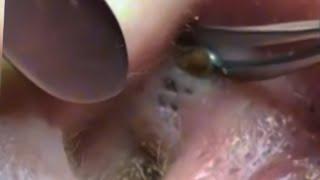 Blackheads Removal  Acne Treatment and Very Satisfying Satisfying Pimple pop #blackheads