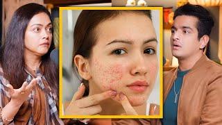 Girls Pimples Kaise Hataye - PCOS & Skin Treatment Hindi Doctor Explanation