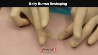 Belly Button Reshaping- Göbek deliği şekillendirme