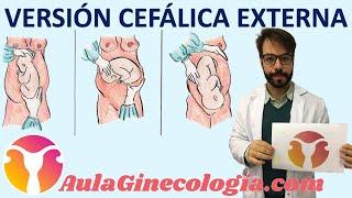 VERSIÓN CEFÁLICA EXTERNA QUÉ ES PARA QUÉ y CÓMO se realiza.   - Ginecología y Obstetricia -