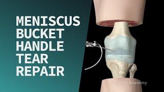 Meniscus Bucket Handle Tear Repair