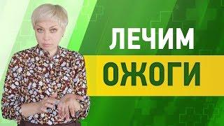 Как лечить ожог6 простых домашних средств.