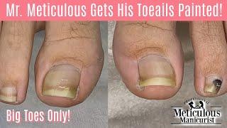 Big Toes Only - Ingrown Toenail & Impacted Toenail Pedicure Relief Causes and Prevention