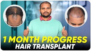 Hair Transplant in Delhi  Best Results & Cost of Hair Transplant in Delhi