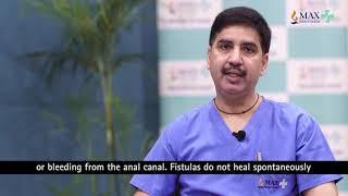 Fistula in Ano- VAAFT - Expert DocTalk with Dr  Vishwas Sharma