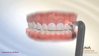 Surgical Treatment for Gummy Smile - Laser Gingivectomy