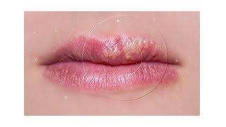 Mayo Clinic Minute 3 things you didnt know about cold sores