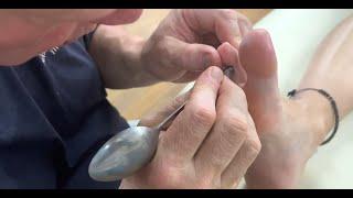 Deep foot reflexology using edge of a spoon to get in deeper. Raynor Naturopathic Massage.