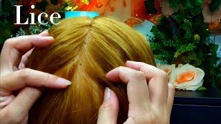 ASMR Lice Removal Pop the Lice directly on the Scalp and nails 