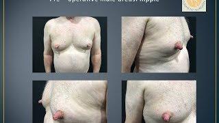 Male nipple reduction performed by Dr Shailesh Vadodaria