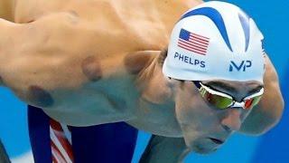 Why Olympians are doing the cupping treatment