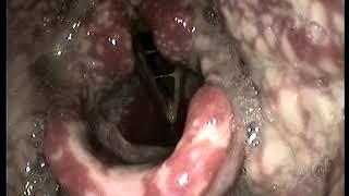 Disseminated gonorrhea scattered fibrinous lesions in the pharynx and larynx