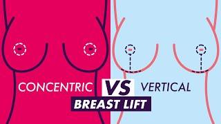 What Type of Breast Lift is Best for Me?