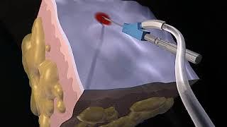 How Liposuction Works Animation - Liposuction Procedure Video