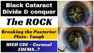 The Black Cataract PHACO - Strategies for The  ROCK... - Dr. Deepak Megur