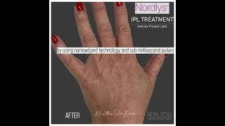 Doctor led Nordlys IPL treatment - Instagram Clip - Real You Clinic