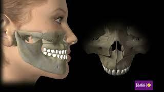 Corrective Jaw Surgery - Maxillary Advancement 3D