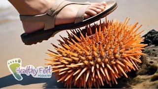 HOW MANY SEA URCHIN SPINES REMOVED FROM FOOT?